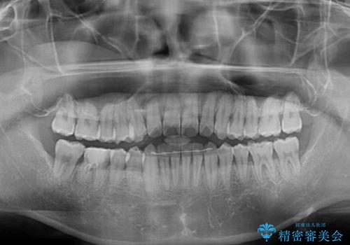 前歯のクロスバイトを改善 インビザラインによる矯正治療の治療後