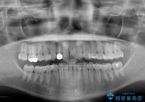 【モニター】前歯のデコボコと変色した前歯をインビザラインとオールセラミッククラウンでの治療後