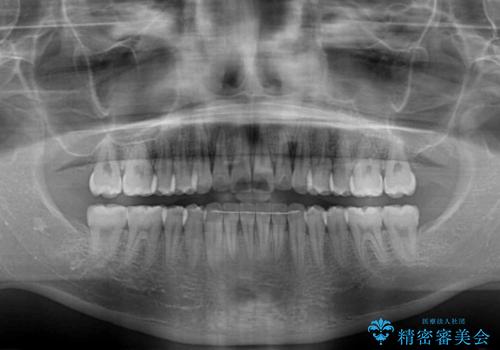 前歯のクロスバイト インビザラインによる矯正治療の治療後