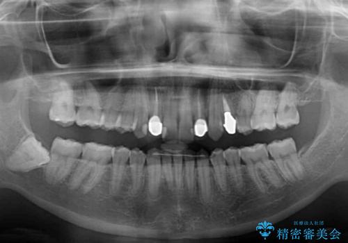 【モニター】前歯の変色とデコボコを改善 インビザラインとオールセラミックの治療後
