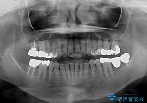 前歯の突出感と上下の隙間 インビザラインによる矯正治療の治療後