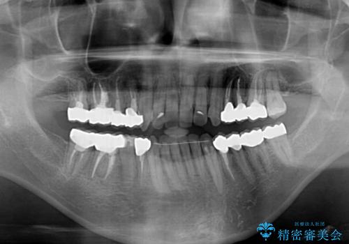 飛び出した前歯と目立つ銀歯 矯正とセラミックの総合歯科診療の治療後