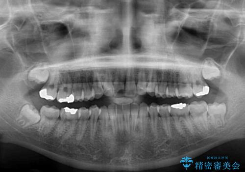 歯をきれいにしたい ワイヤー矯正治療と虫歯治療の治療前