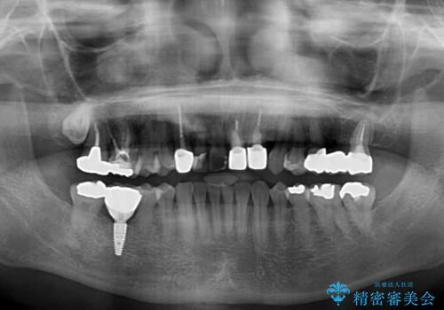 歯が全く咬みあわない 矯正と補綴の全顎治療の治療後
