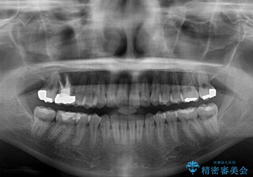 歯をきれいにしたい ワイヤー矯正治療と虫歯治療の治療後