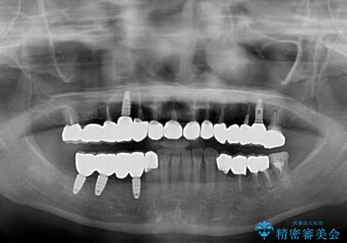以前治療した歯がボロボロに 全顎補綴治療の治療後