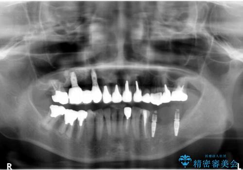 全顎的 虫歯治療 インプラント補綴の治療中