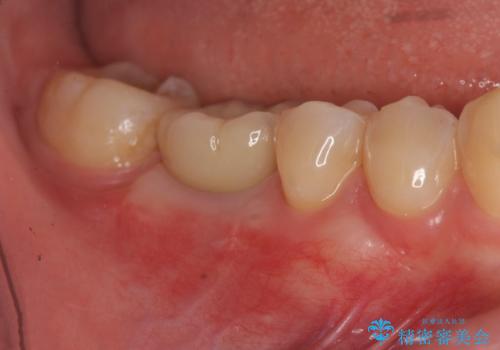 保存不可能な虫歯、インプラントによる機能回復の症例 治療後