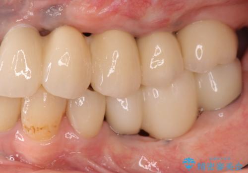 全顎的 虫歯治療 インプラント補綴の治療後