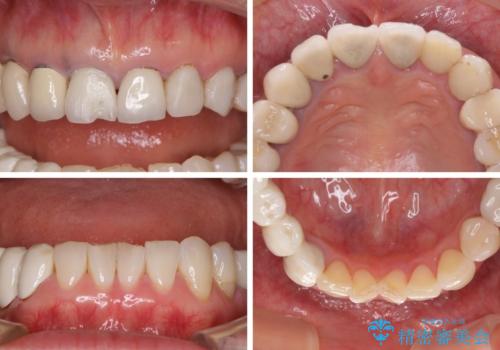 以前治療した歯がボロボロに 全顎補綴治療の治療前