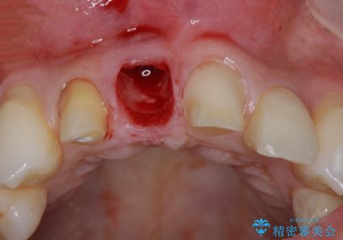 吸収し喪失した前歯、ブリッジによる審美性の回復の治療前