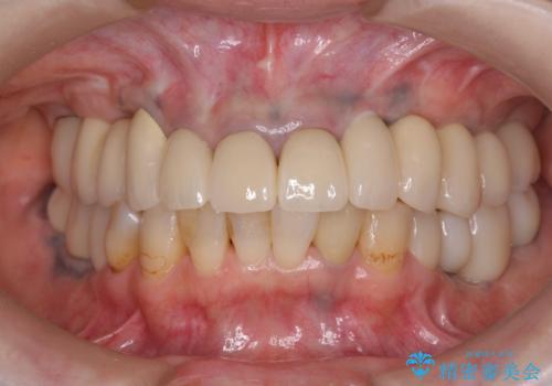 全顎的 虫歯治療 インプラント補綴の治療後