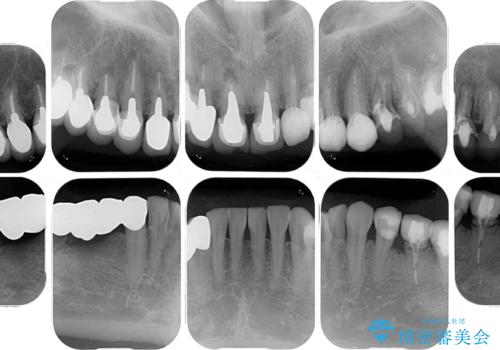 以前治療した歯がボロボロに 全顎補綴治療の治療前