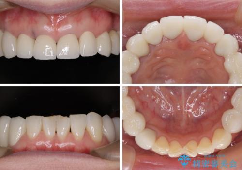 以前治療した歯がボロボロに 全顎補綴治療の治療後