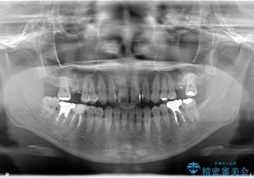 【歯牙移植】親知らずを移植して、インプラントを回避。の治療前