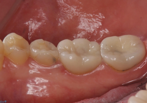 樹脂で継ぎ接ぎになった歯 セラミッククラウンでの治療の治療前