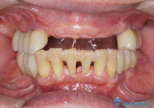 [ 無歯顎の治療 ]   前歯部義歯と臼歯部インプラント補綴の治療中