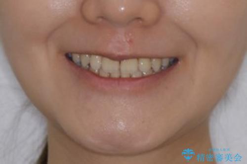 コロナ禍で矯正治療が中断:インビザラインで最終仕上げの治療後(顔貌)