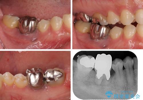歯が全く咬みあわない 矯正と補綴の全顎治療の治療前