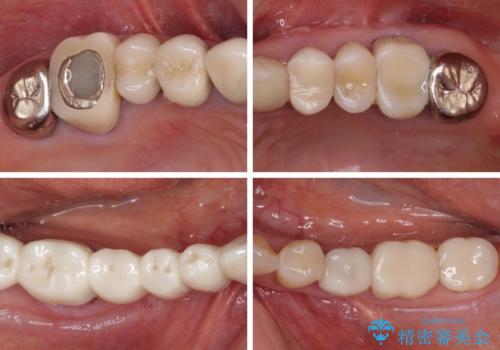 以前治療した歯がボロボロに 全顎補綴治療の治療前