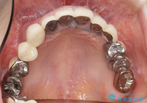 全顎的 虫歯治療 インプラント補綴の治療前