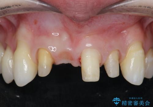 吸収し喪失した前歯、ブリッジによる審美性の回復の治療中