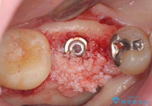 保存不可能な虫歯、インプラントによる機能回復の治療中