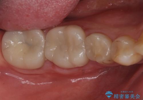 樹脂で継ぎ接ぎになった歯 セラミッククラウンでの治療の治療前