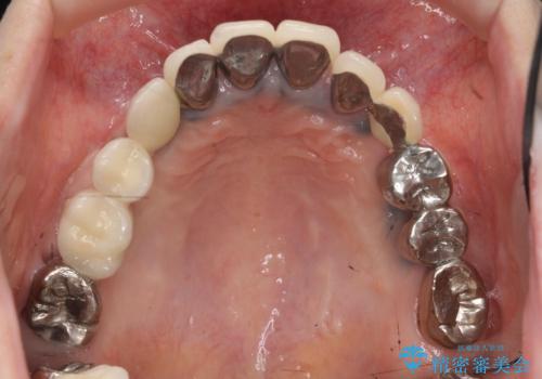 全顎的 虫歯治療 インプラント補綴の治療中