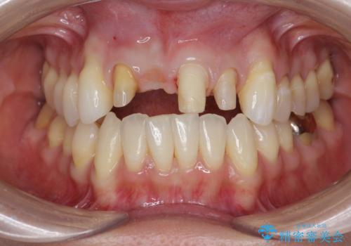 吸収し喪失した前歯、ブリッジによる審美性の回復の治療中