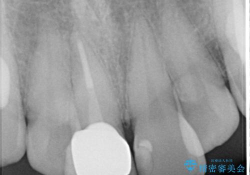 【オールセラミック】前歯の色を変えたい。の治療後