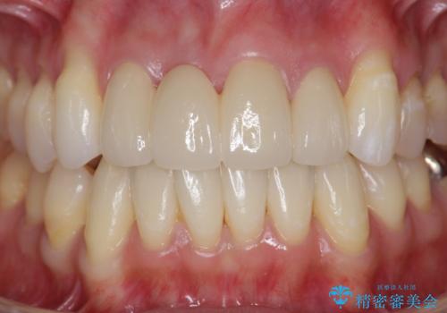 吸収し喪失した前歯、ブリッジによる審美性の回復の治療後