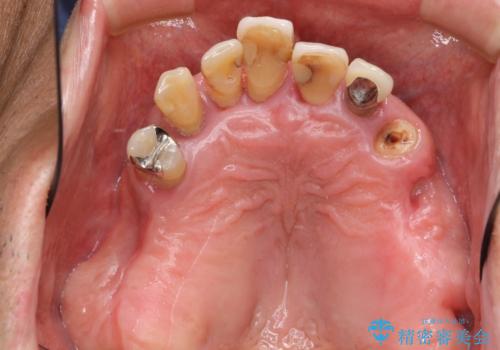 [ 無歯顎の治療 ]   前歯部義歯と臼歯部インプラント補綴の治療前