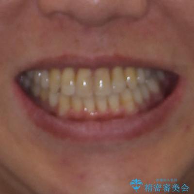 飛び出した前歯と目立つ銀歯 矯正とセラミックの総合歯科診療の治療後(顔貌)