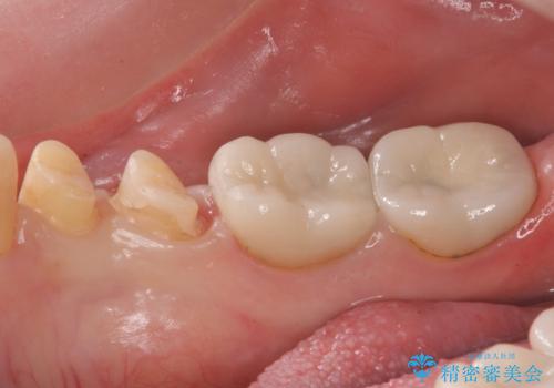 樹脂で継ぎ接ぎになった歯 セラミッククラウンでの治療の治療中