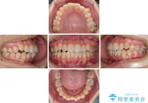 カリエール・ディスタライザーとインビザラインを用いた八重歯の改善の治療中