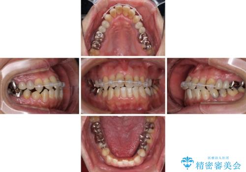 飛び出した前歯と目立つ銀歯 矯正とセラミックの総合歯科診療の治療中