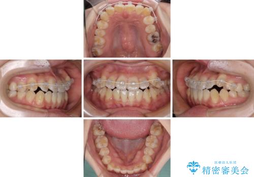 前歯のデコボコを改善　ワイヤー矯正を併用したインビザライン矯正の治療中