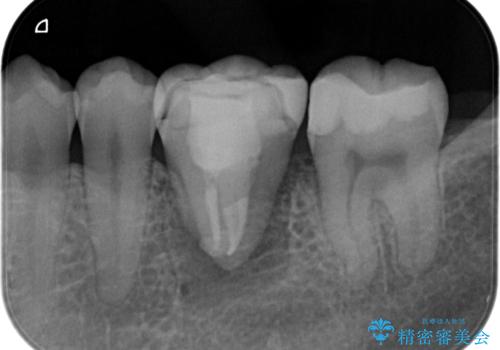 【歯牙移植】親知らずを移植して、インプラントを回避。の治療中