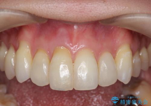 吸収し喪失した前歯、ブリッジによる審美性の回復の治療前