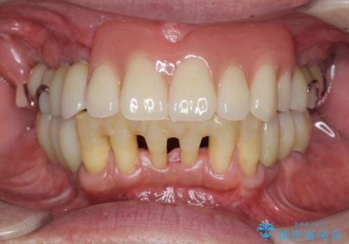 [ 無歯顎の治療 ]   前歯部義歯と臼歯部インプラント補綴の治療後