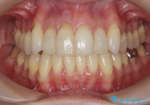 吸収し喪失した前歯、ブリッジによる審美性の回復の治療前