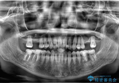 【歯牙移植】親知らずを移植して、インプラントを回避。の治療後