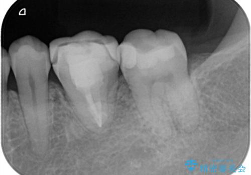 【歯牙移植】親知らずを移植して、インプラントを回避。の症例 治療後