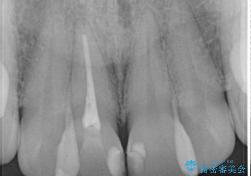 【オールセラミック】前歯の色を変えたい。の治療前