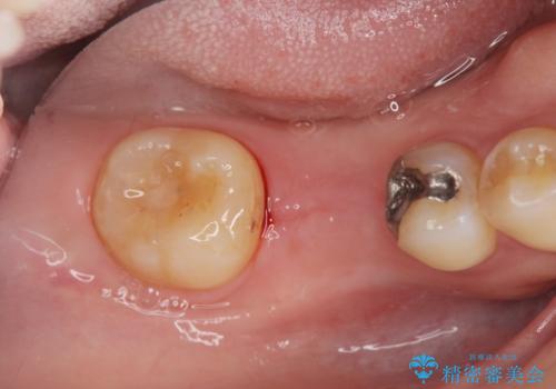 保存不可能な虫歯、インプラントによる機能回復の治療中