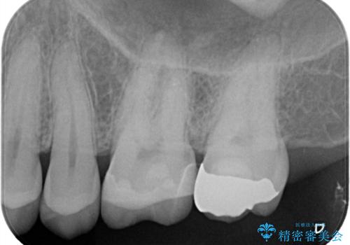 【セラミックインレー】歯科検診にて虫歯発見。の治療後