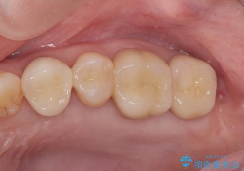 [ 歯肉縁下カリエス ]    歯周外科を行い、歯を残すの治療後