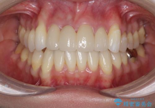 吸収し喪失した前歯、ブリッジによる審美性の回復の治療後