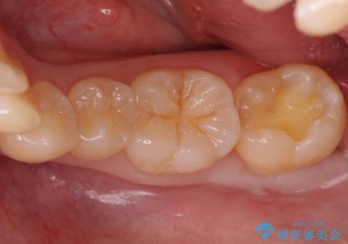 奥歯の虫歯 セラミックインレーでの治療の治療中